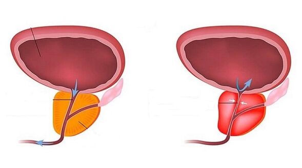 Gesunde Prostata und mit Prostatitis entzündet