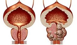 Gesunde und ungesunde Prostata
